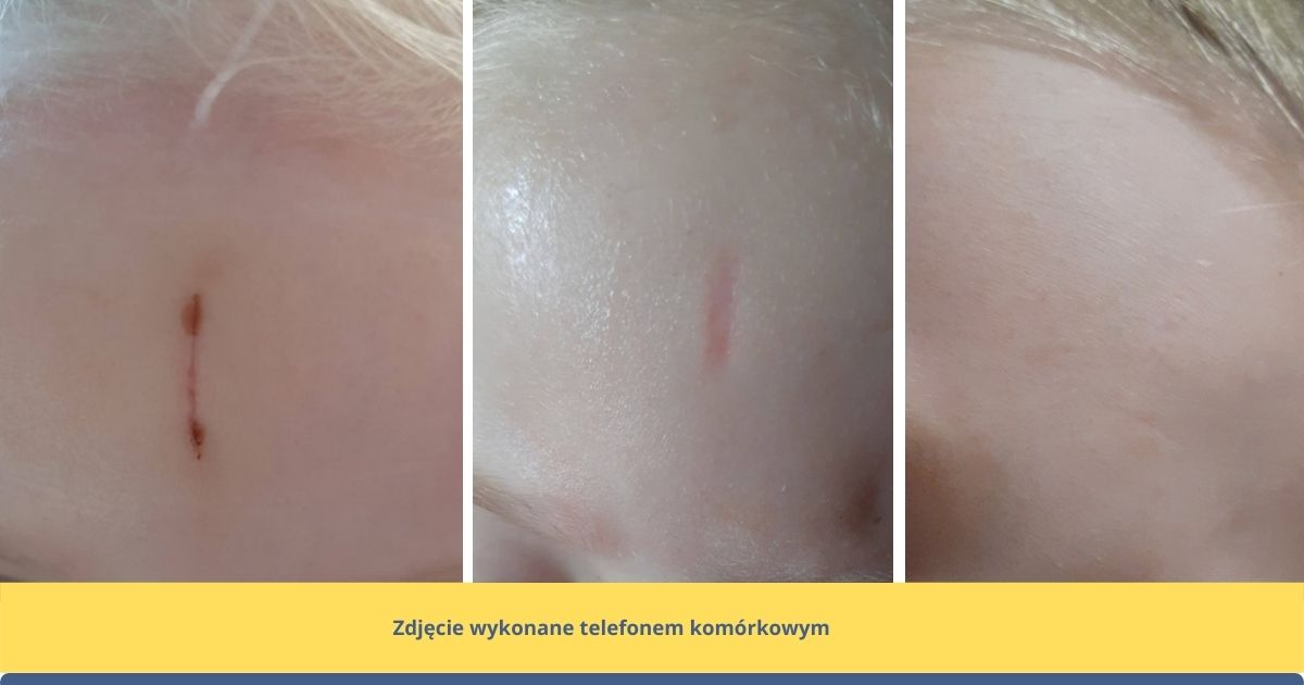 efekty stosowania żelu Contactubex na bliznę u dziecka